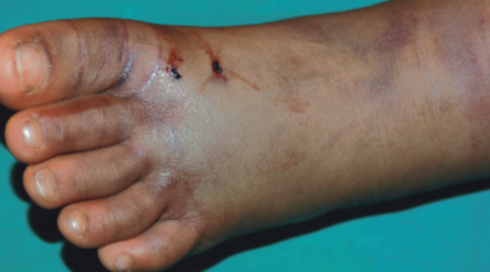 सर्पको टोकाइबाट कैलालीमा एक महिला घाइते