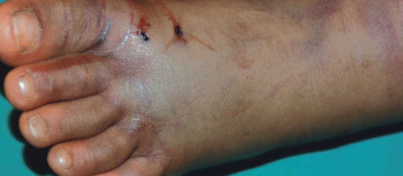 सर्पको टोकाइबाट कैलालीमा एक महिला घाइते